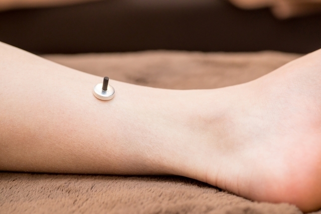 西宮市の鍼灸院松本はりきゅう施術院のきゅう施術の写真